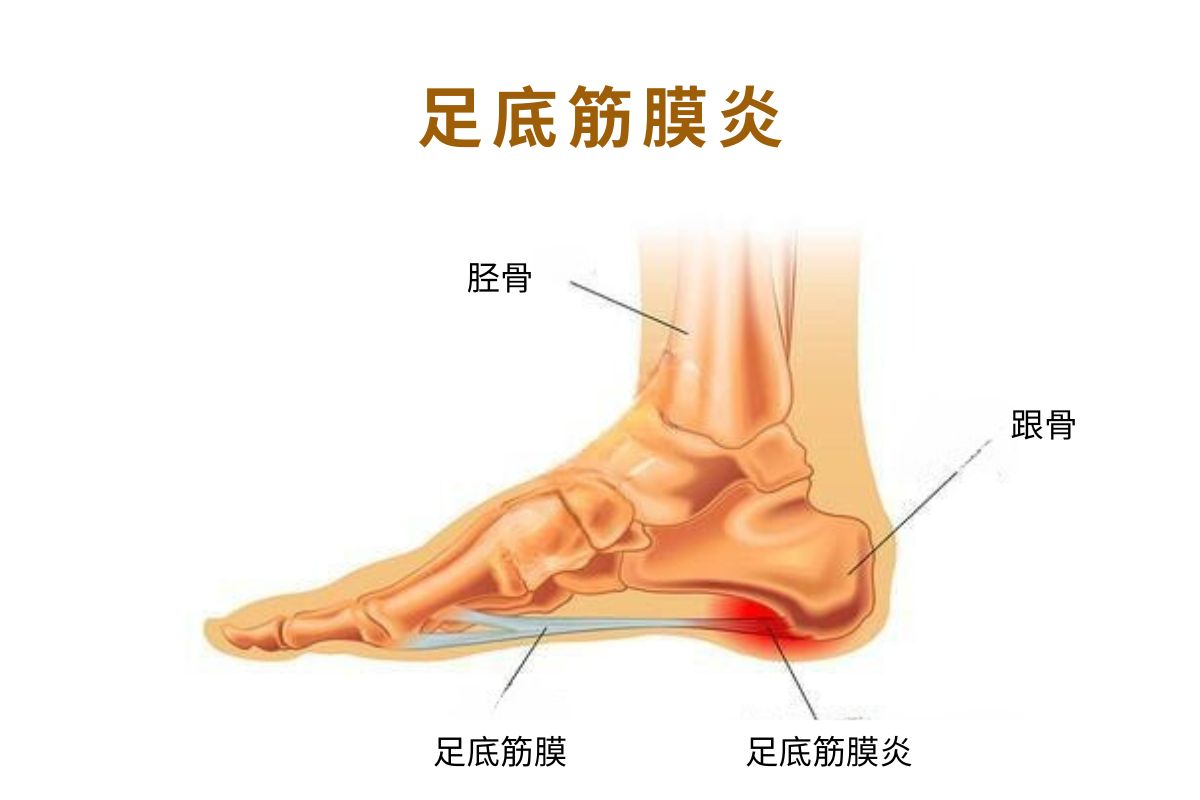 足底疼痛 脚底痛 足底筋膜炎