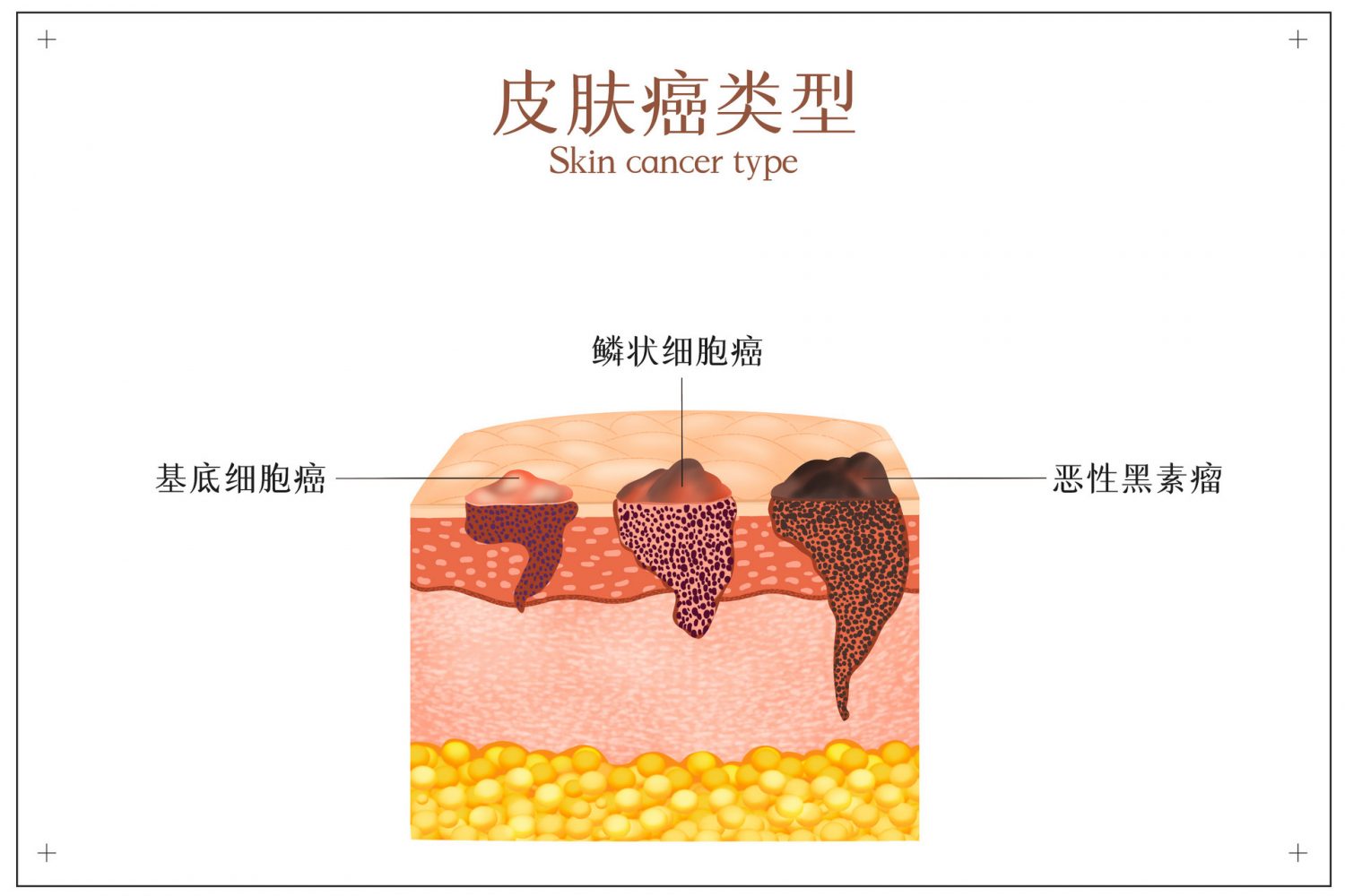 鳞状细胞癌（SCC）是皮肤癌中的一种常见类型，它的危险性在于其侵袭性强、易于扩散。