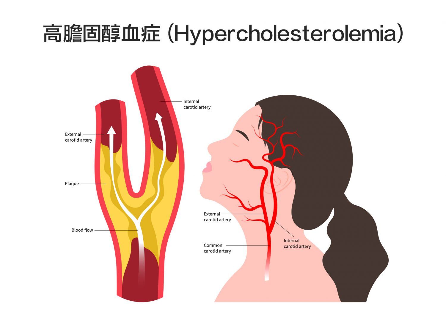 高膽固醇血症：如何識別風險並成功管理？